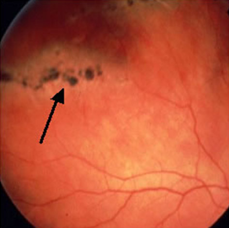 Degeneración Lattice