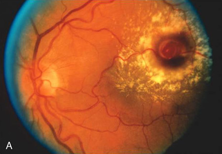 macroaneurisma y diabetes