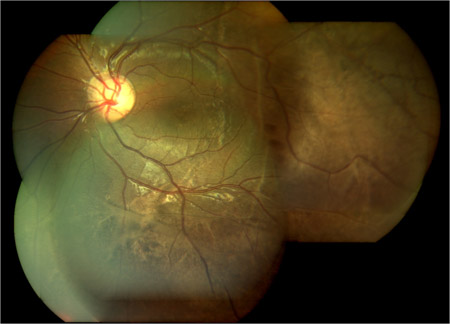 Retinosquisis Retina en México